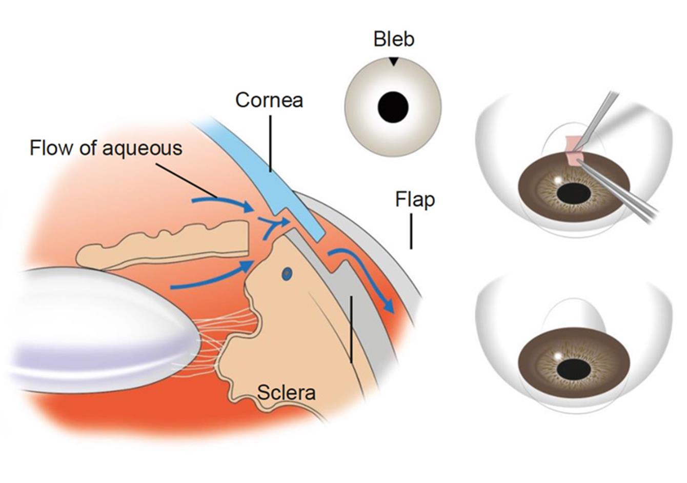 Trabeculectomy